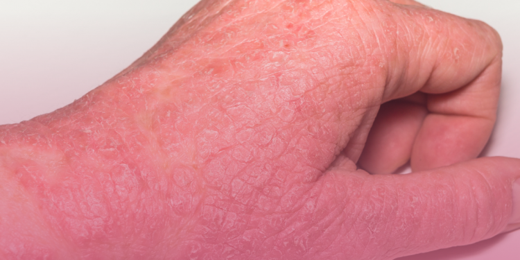 Dermatite atópica: participe das consultas públicas para incorporação de novos medicamentos no SUS