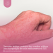 Dermatite atópica: participe das consultas públicas para incorporação de novos medicamentos no SUS