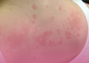 Consultas públicas abertas para disponibilização de novos medicamentos para dermatite atópica