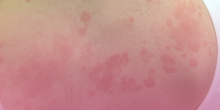 Consultas públicas abertas para disponibilização de novos medicamentos para dermatite atópica