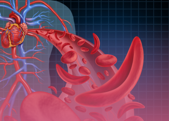SUS vai disponibilizar dois novos medicamentos para a doença falciforme