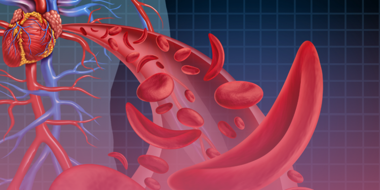 SUS vai disponibilizar dois novos medicamentos para a doença falciforme