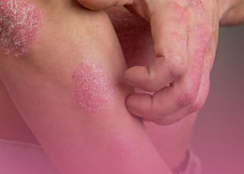 Psoríase Brasil promove 3º Simpósio Doenças Crônicas de Pele em São Paulo