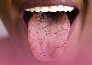 Doença de Sjögren é síndrome rara que também pode afetar os pulmões