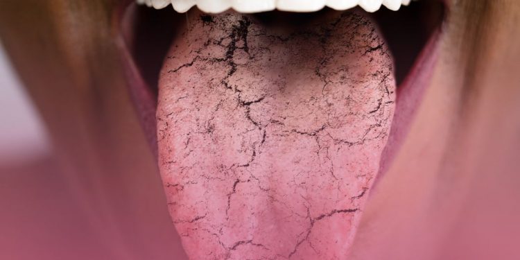 Doença de Sjögren é síndrome rara que também pode afetar os pulmões