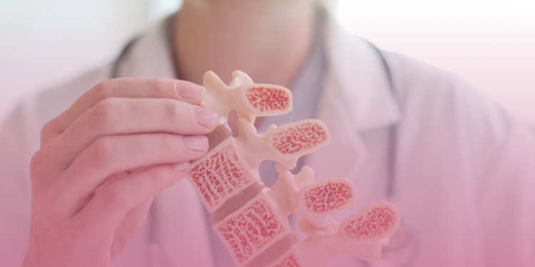 Campanha contra osteoporose chama atenção para a osteossarcopenia