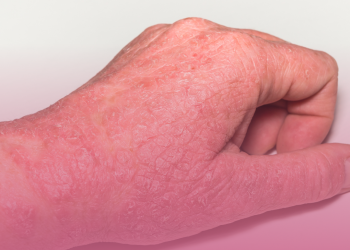 Dermatite Atópica: O Que Você Precisa Saber