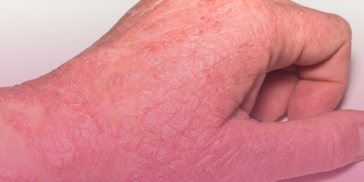 Dermatite Atópica: O Que Você Precisa Saber