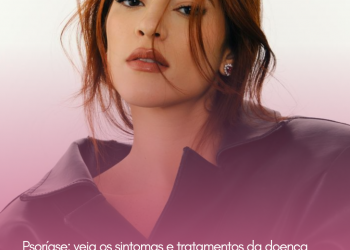 Psoríase: veja os sintomas e tratamentos da doença autoimune incurável que acomete a apresentadora Ana Clara
