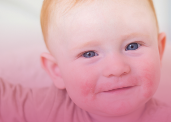 Dermatite atópica: terapia avançada será incorporada no SUS para crianças