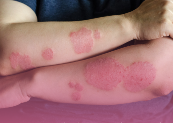 Psoríase: cientistas descobrem o que pode ser origem da doença crônica de pele; entenda