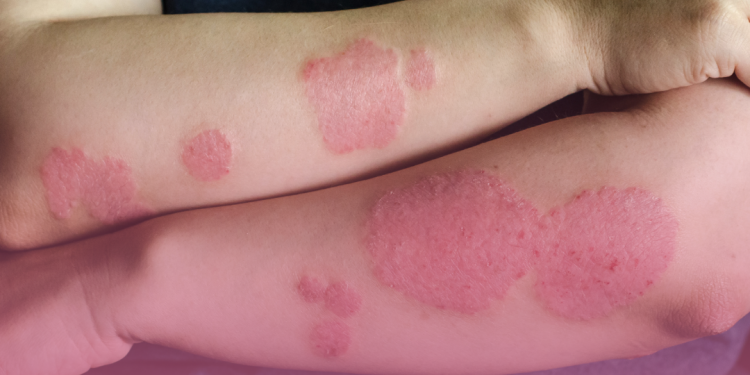 Psoríase: cientistas descobrem o que pode ser origem da doença crônica de pele; entenda