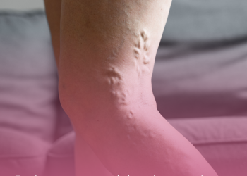 Trombose: mitos e verdades sobre uma doença silenciosa