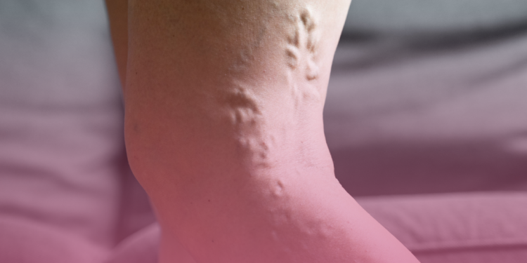 Trombose: mitos e verdades sobre uma doença silenciosa