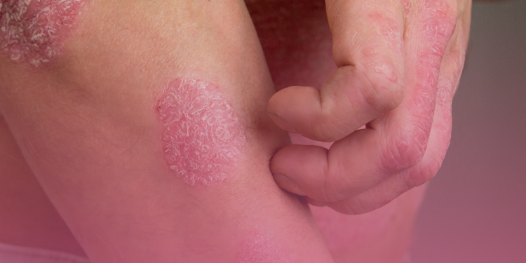 Dia Mundial da Psoríase: o que é, quais são os sintomas, tratamentos e prevenção