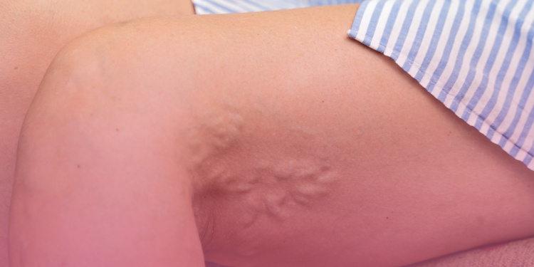 Risco de trombose aumenta após trauma ou cirurgia; entenda