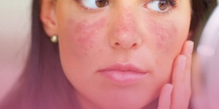 Olho seco pode ser doença de Sjögren