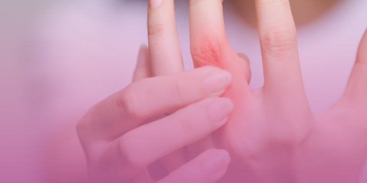 Artrite reumatoide – alterações laboratoriais e prognóstico.