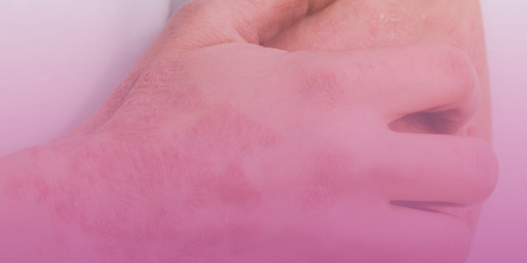 Alterações na pele podem indicar doença reumática