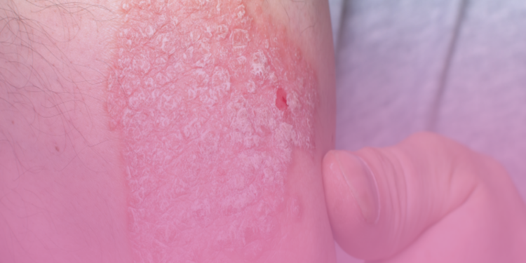 Psoríase: doença na pele pode ser a ponta do iceberg