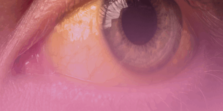 Hepatite viral: falta de diagnóstico é o principal empecilho para erradicá-la