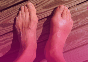 Dores reumáticas podem gerar incapacidade profissional