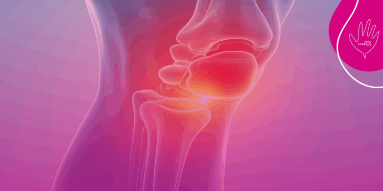 Artrose: por que César Filho precisou de mais uma cirurgia e como evitar a doença