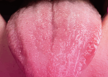 Confira o Biored Explica: Doença de Sjögren, enfermidade autoimune rara pode afetar também os pulmões