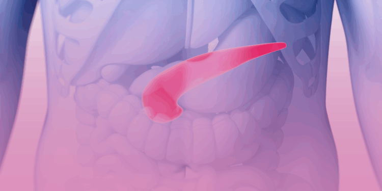 Nova evidência reforça o diabetes como marcador do câncer de pâncreas