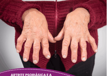 Artrite Psoriásica e a importância da abordagem multiprofissional