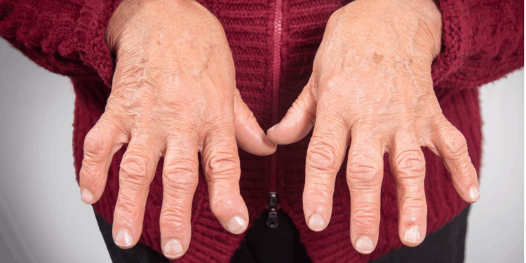 Artrite Psoriásica e a importância da abordagem multiprofissional