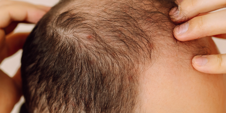 Novo medicamento oral contra queda de cabelo promete maior eficácia e menos riscos à saúde