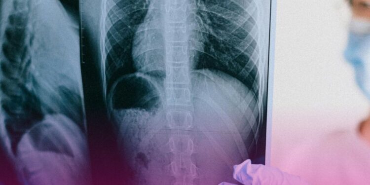 Cosaúde analisa contribuições e debate propostas de incorporação de novas tecnologias para o tratamento do câncer colorretal metastático, câncer de próstata e câncer de pulmão