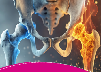 O que Fazer para Prevenir a Osteoporose.