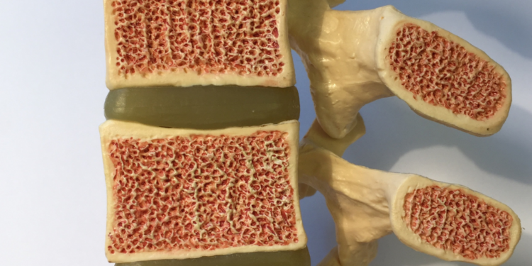 Cuidar dos ossos é cuidar da vida: como prevenir a osteoporose