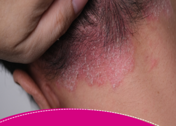 Renata Saldanha fala sobre viver com psoríase: ‘A gente luta contra o próprio corpo’