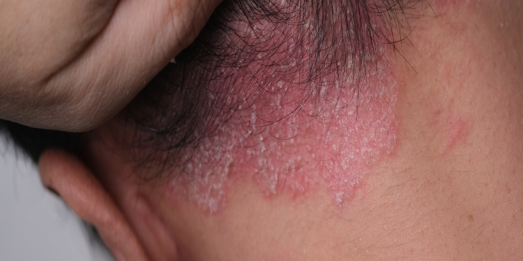 Renata Saldanha fala sobre viver com psoríase: ‘A gente luta contra o próprio corpo’