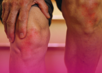 Dor e inchaço nas juntas costumam indicar artrite em fase inicial