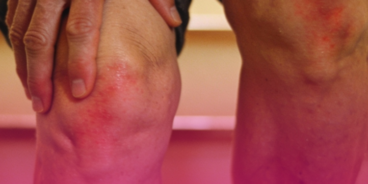 Dor e inchaço nas juntas costumam indicar artrite em fase inicial