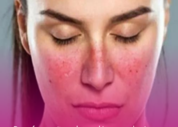 Desinformação sobre o lúpus ainda é um desafio para pacientes e especialistas