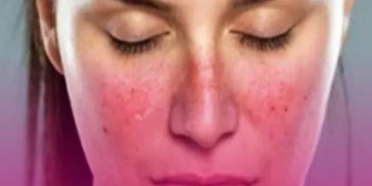 Desinformação sobre o lúpus ainda é um desafio para pacientes e especialistas