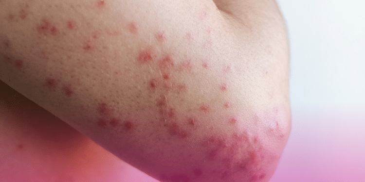 Rede global de virologistas alerta para ressurgimento do sarampo em meio ao pior surto da doença em 30 anos nos EUA