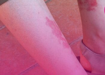 Tecnologia de implante auditivo para perda auditiva é tema de consulta pública da Comissão Nacional de Incorporação de Tecnologias no SUS