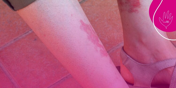 Tecnologia de implante auditivo para perda auditiva é tema de consulta pública da Comissão Nacional de Incorporação de Tecnologias no SUS