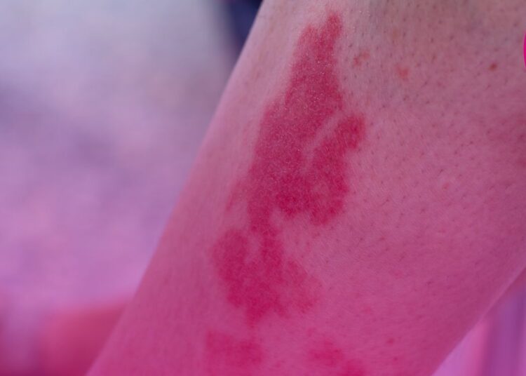 Tecnologia de implante auditivo para perda auditiva é tema de consulta pública da Comissão Nacional de Incorporação de Tecnologias no SUS