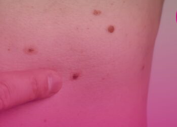 Tecnologia de implante auditivo para perda auditiva é tema de consulta pública da Comissão Nacional de Incorporação de Tecnologias no SUS