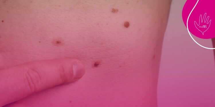 Tecnologia de implante auditivo para perda auditiva é tema de consulta pública da Comissão Nacional de Incorporação de Tecnologias no SUS