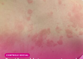 Cosaúde analisa contribuições e debate propostas de incorporação de novas tecnologias para o tratamento da dermatite atópica, fibrilação atrial e câncer de próstata