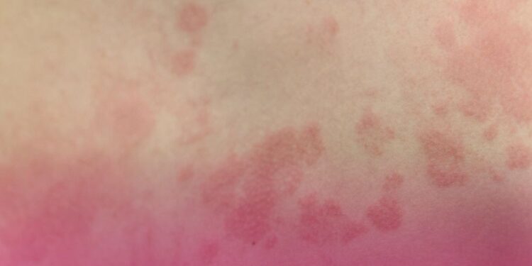 Cosaúde analisa contribuições e debate propostas de incorporação de novas tecnologias para o tratamento da dermatite atópica, fibrilação atrial e câncer de próstata