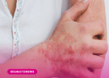 Hanseníase: Brasil registrou mais de 300 mil casos da doença em dez anos